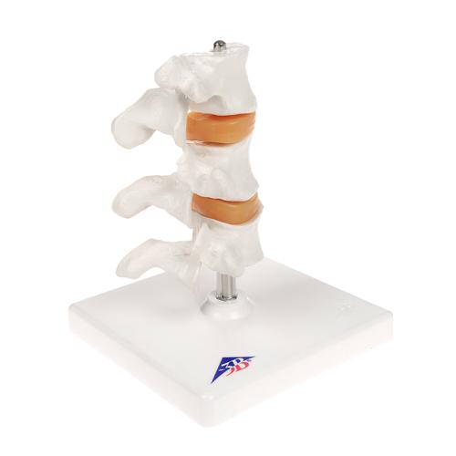 Deluxe csontritkulás modell (3 csigolya) - 3B Smart Anatomy, 1000153 [A78], Ízületi gyulladással és csontritkulással kapcsolatos oktatás