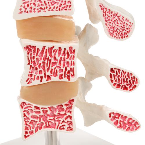 Deluxe csontritkulás modell (3 csigolya) - 3B Smart Anatomy, 1000153 [A78], Ízületi gyulladással és csontritkulással kapcsolatos oktatás