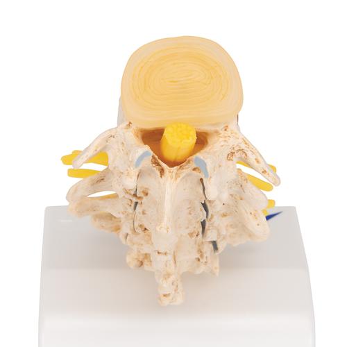 Porckorongsérv és gerinc-degeneráció stádiumai - 3B Smart Anatomy, 1000158 [A795], Csigolyamodellek