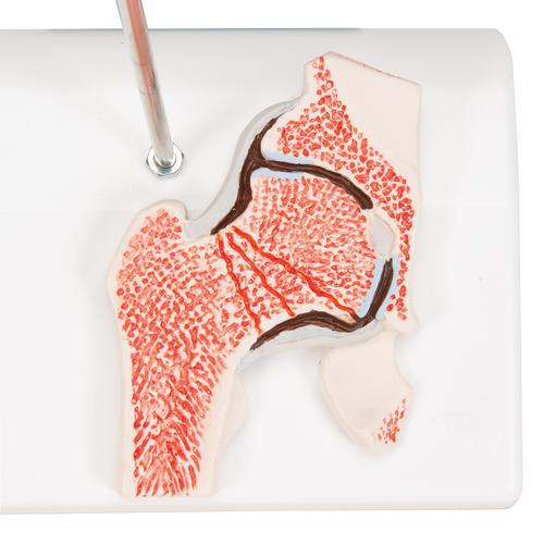 Combcsonttörés és csípőízületi gyulladás - 3B Smart Anatomy, 1000175 [A88], Ízületi gyulladással és csontritkulással kapcsolatos oktatás