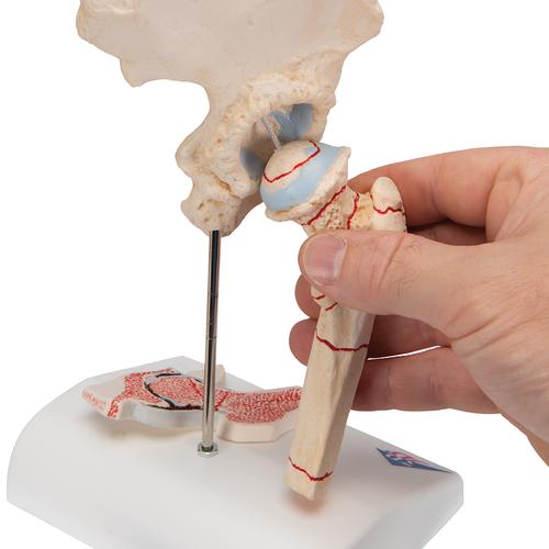 Combcsonttörés és csípőízületi gyulladás - 3B Smart Anatomy, 1000175 [A88], Ízületi gyulladással és csontritkulással kapcsolatos oktatás