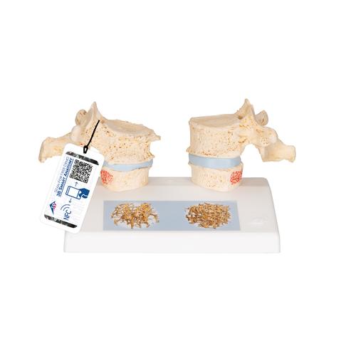 Csontritkulás modell - 3B Smart Anatomy, 1000182 [A95], Ízületi gyulladással és csontritkulással kapcsolatos oktatás