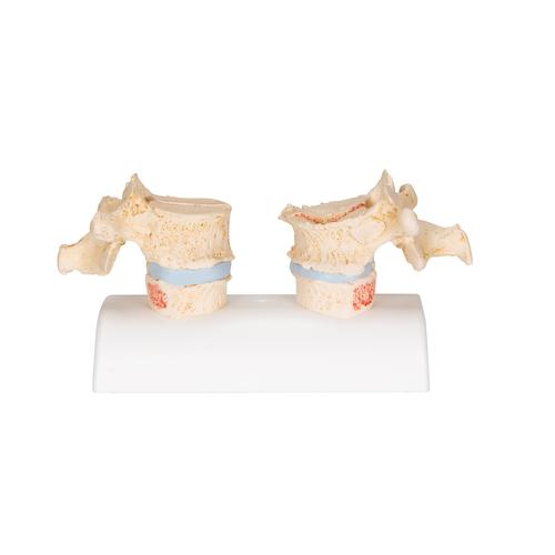 Csontritkulás modell - 3B Smart Anatomy, 1000182 [A95], Ízületi gyulladással és csontritkulással kapcsolatos oktatás