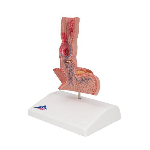 A nyelőcső betegségei - 3B Smart Anatomy, 1000305 [K18], Emésztőrendszeri modellek
