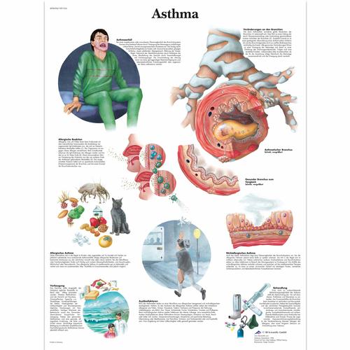 Asthma, 1001354 [VR0328L], Asztmával és allergiákkal kapcsolatos oktatás