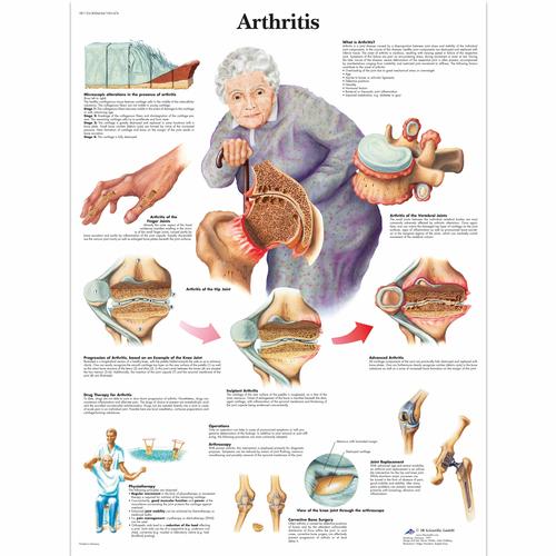 Arthritis, 1001474 [VR1123L], Ízületi gyulladással és csontritkulással kapcsolatos oktatás