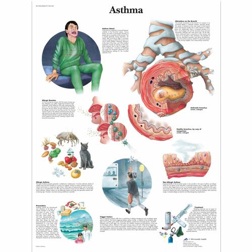 Asthma, 1001520 [VR1328L], Légzőrendszer