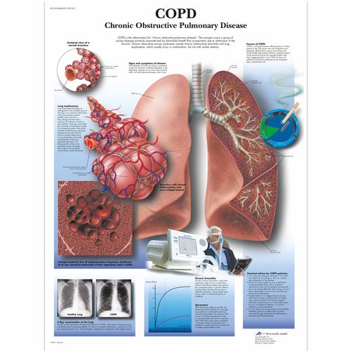 COPD Chronic Obstructive Pulmonary Disease, 1001522 [VR1329L], Légzőrendszer