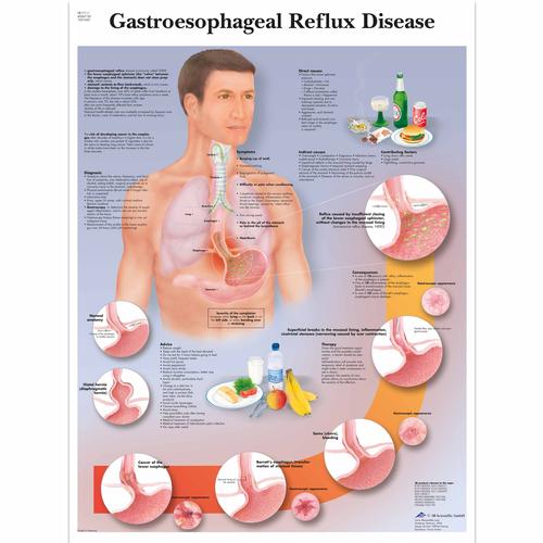 Gastroesophageal reflux disease, 1001602 [VR1711L], Emésztőrendszer