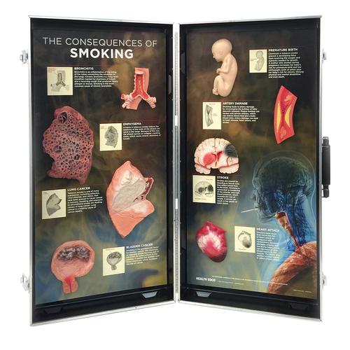 A dohányzás következményei – 3 dimenziós bemutató tábla, 1005580 [W43047], Dohányzással kapcsolatos oktatás