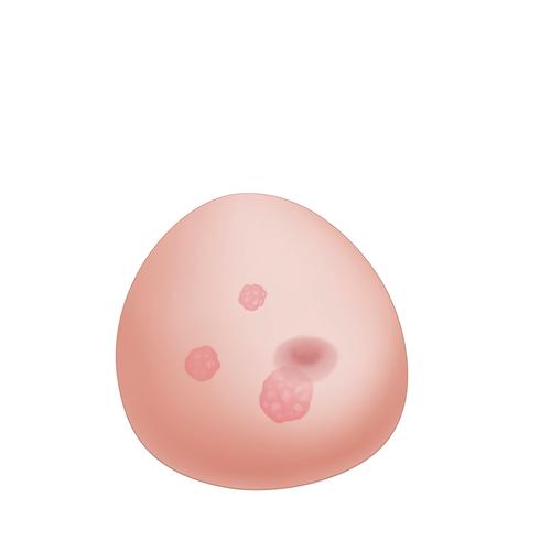 SONOtrain mell modell tumorral– Pót mellkas, 1019650 [XP125], Consumables