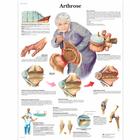 Arthrose, 1001308 [VR0123L], Ízületi gyulladással és csontritkulással kapcsolatos oktatás