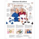 Alzheimer-Krankheit, 1001428 [VR0628L], Agy és idegrendszer