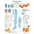Varicose Veins, 4006684 [VR1367UU], Kardiovaszkuláris rendszer