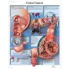 Colon Cancer, 1001550 [VR1432L], Rák