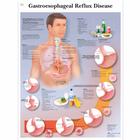 Gastroesophageal reflux disease, 1001602 [VR1711L], Emésztőrendszer