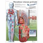 Thrombose veineuse profonde, 1001703 [VR2368L], Kardiovaszkuláris rendszer